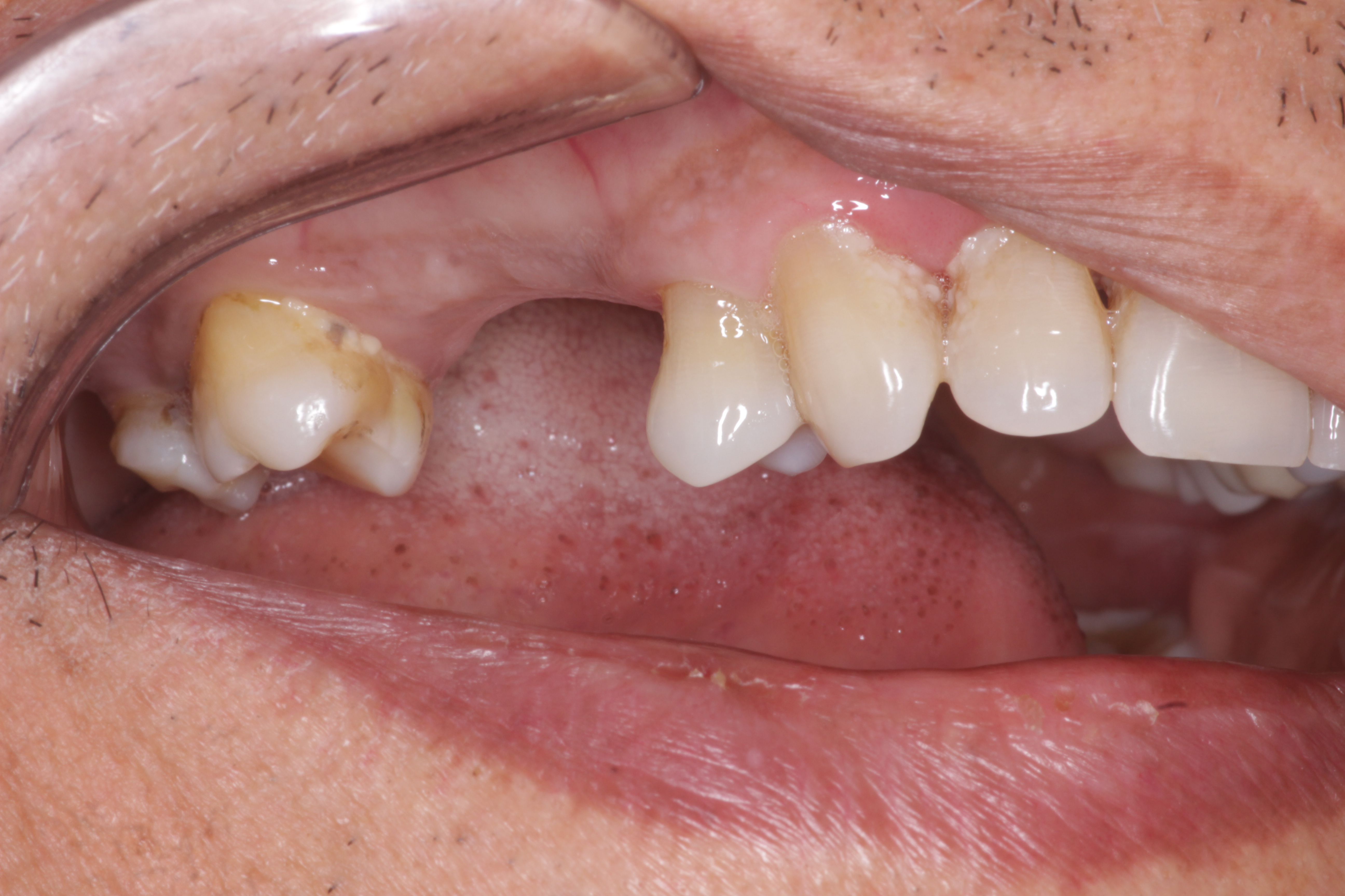 Crowns Before